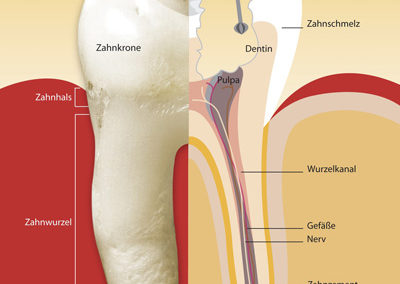 Wurzelbehandlung 2